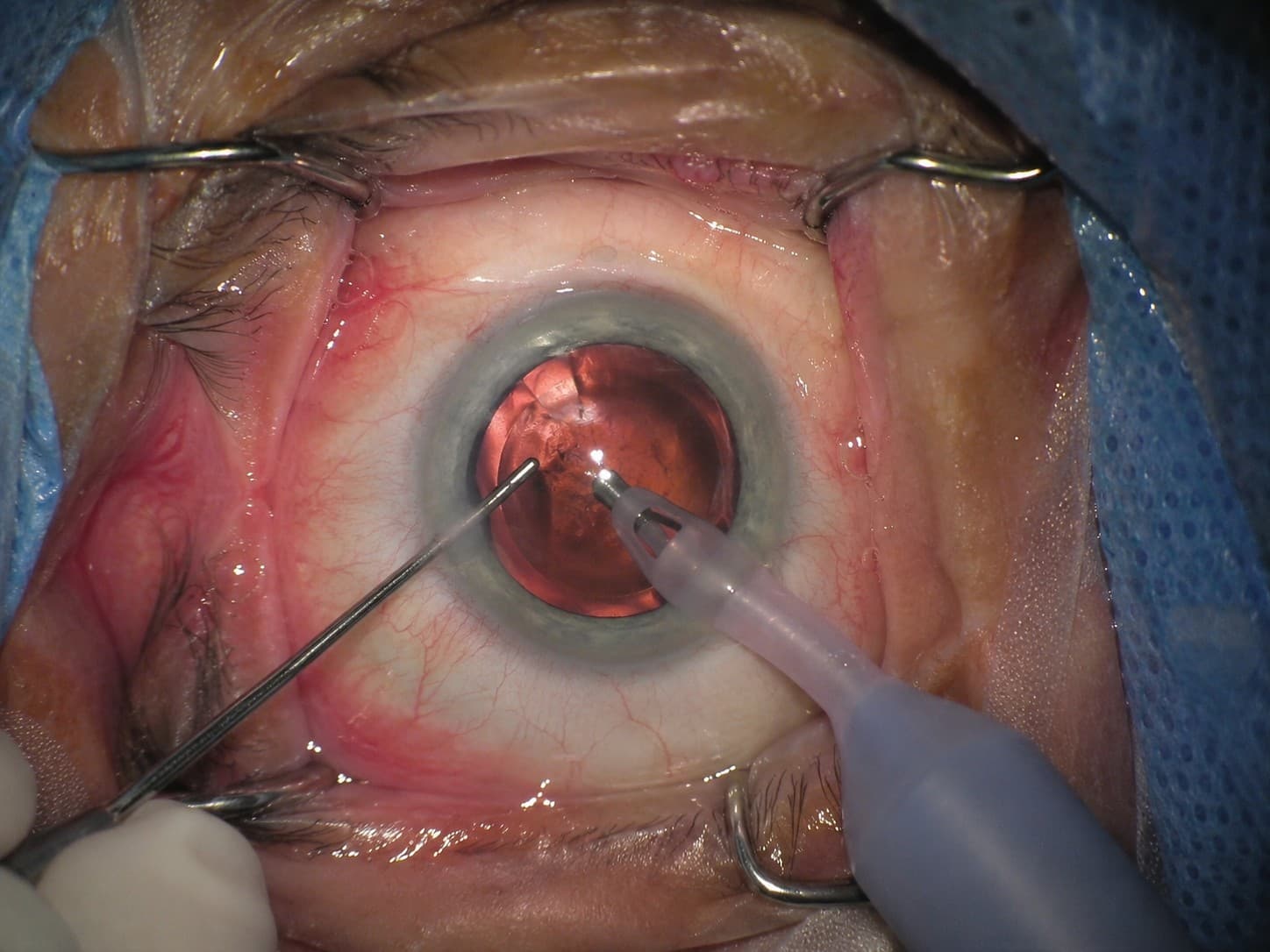Como é feita a cirurgia de catarata?
