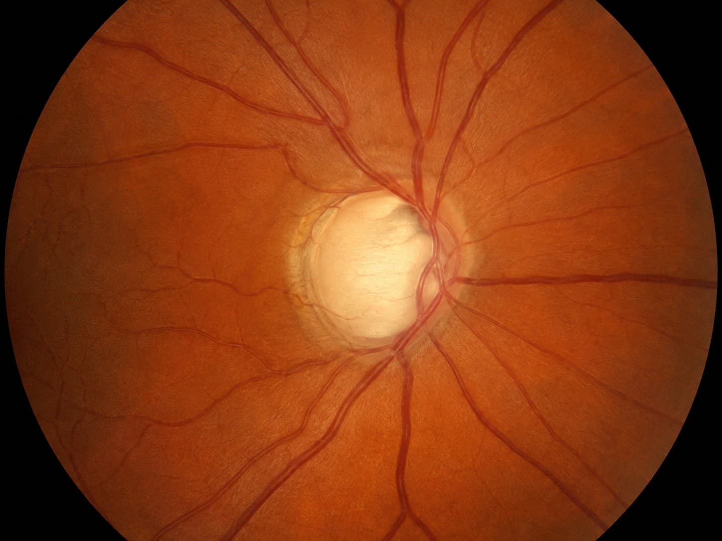 O Que É Glaucoma?