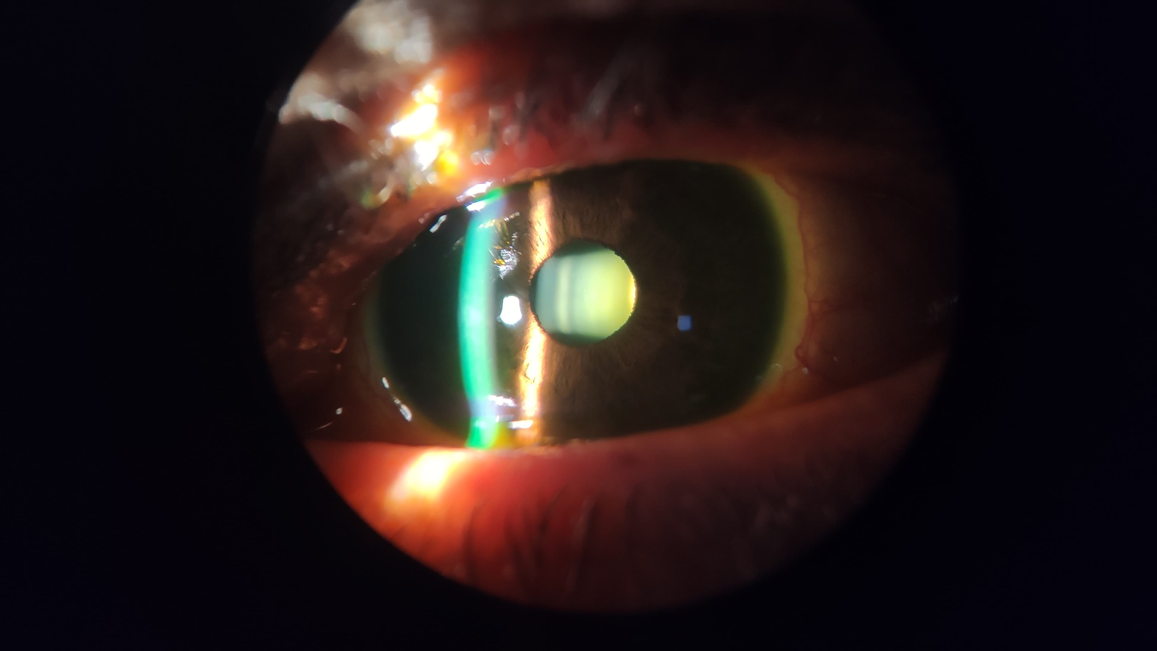 Cirurgia de catarata